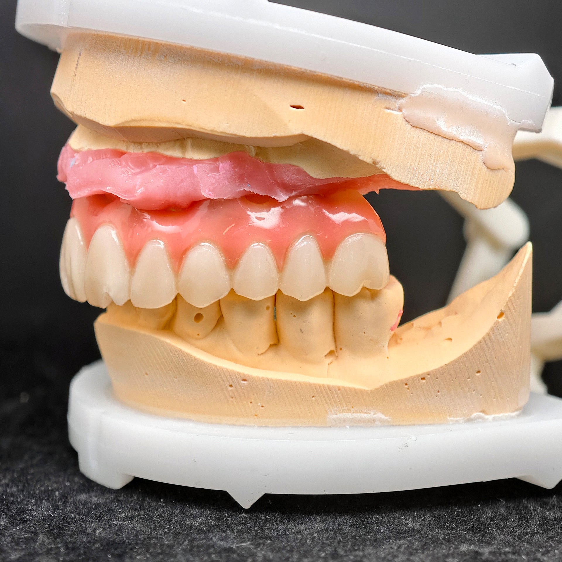 Pmma Bridge With Screw-Retained