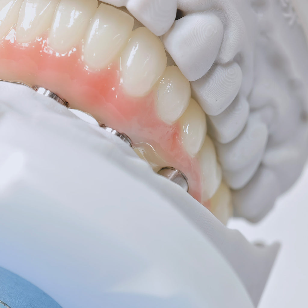 PMMA Bridge With Screw Retained