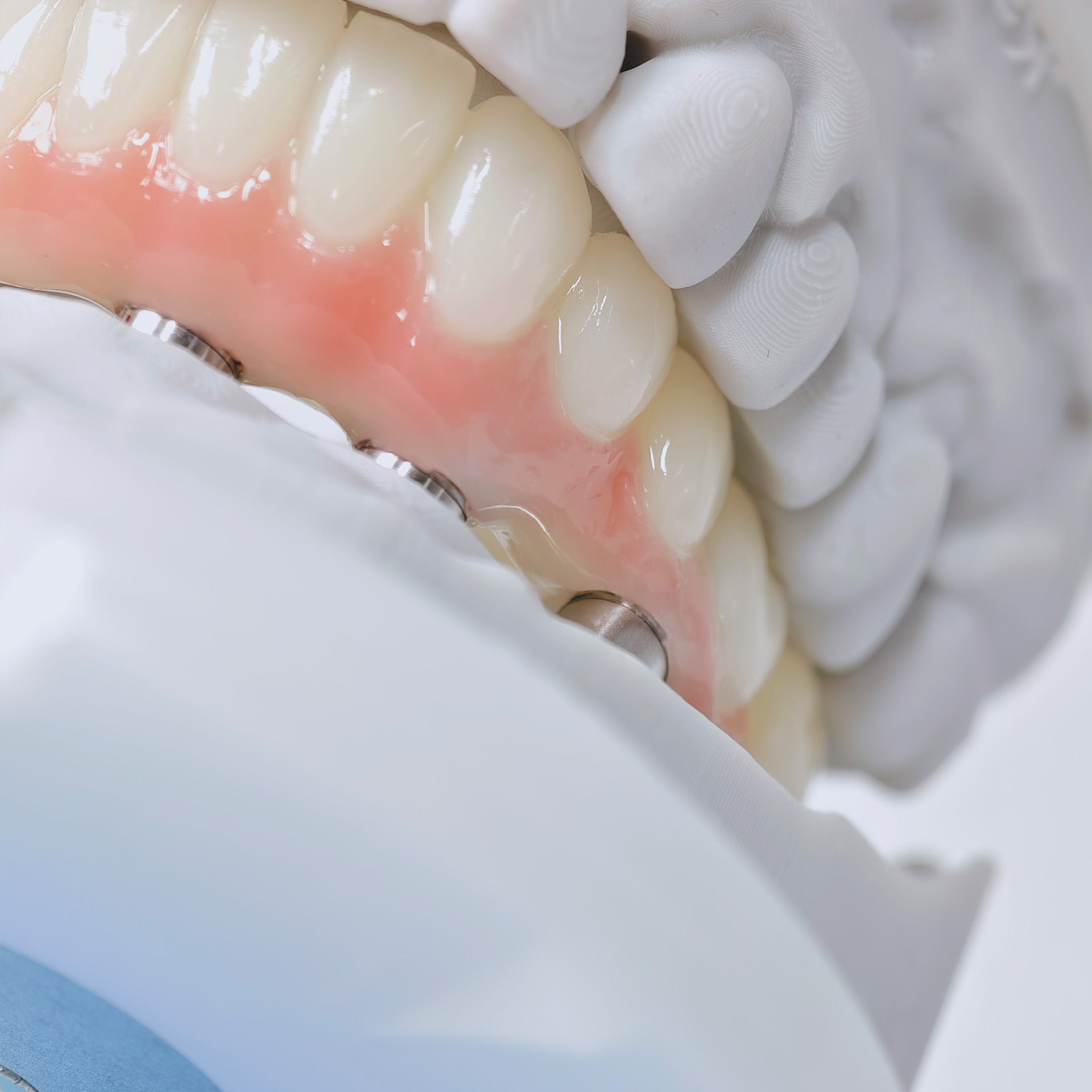 PMMA Bridge With Screw Retained
