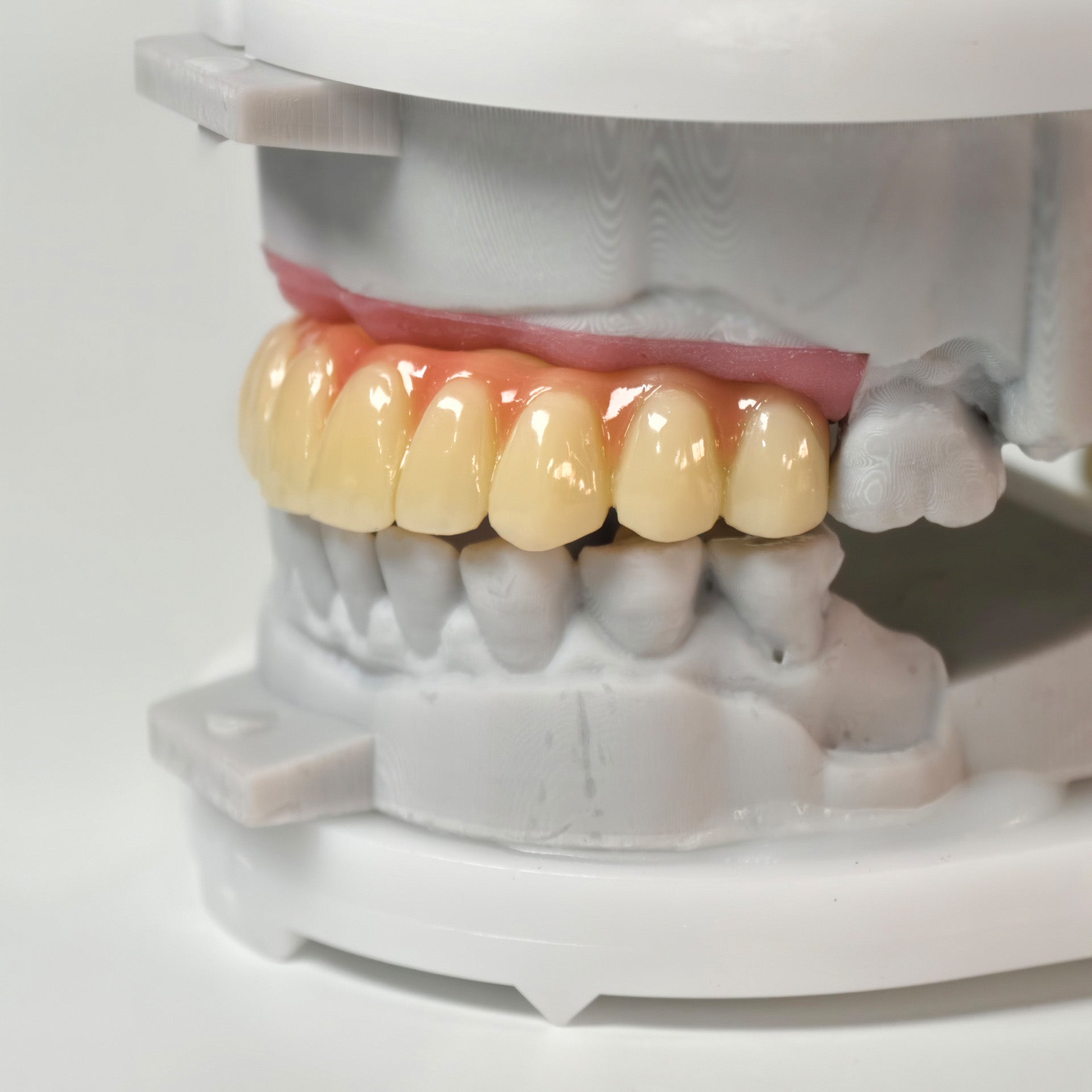 PMMA Bridge With Screw Retained