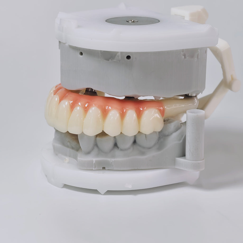 PMMA Bridge With Screw Retained