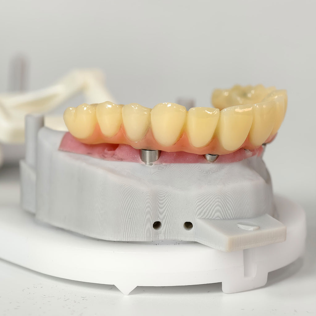 PMMA Bridge With Screw Retained