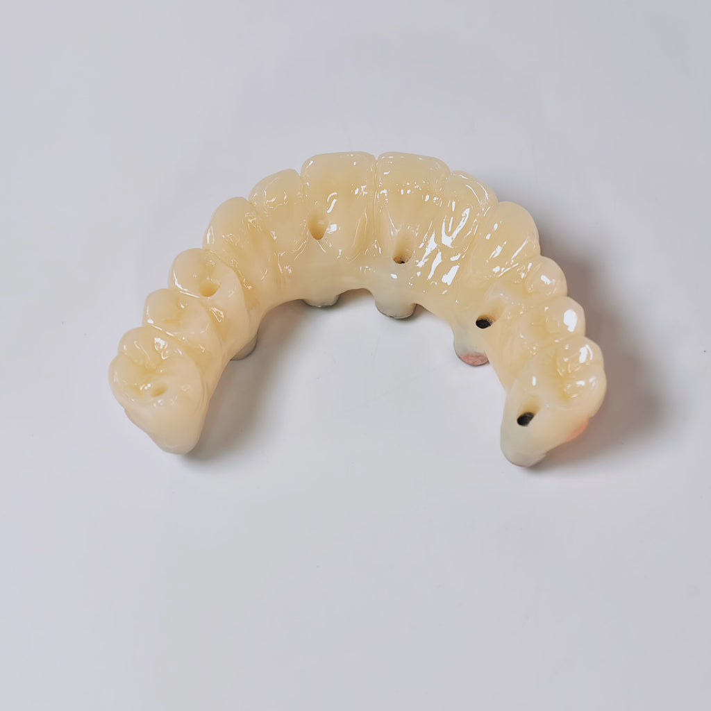 PMMA Bridge With Screw Retained