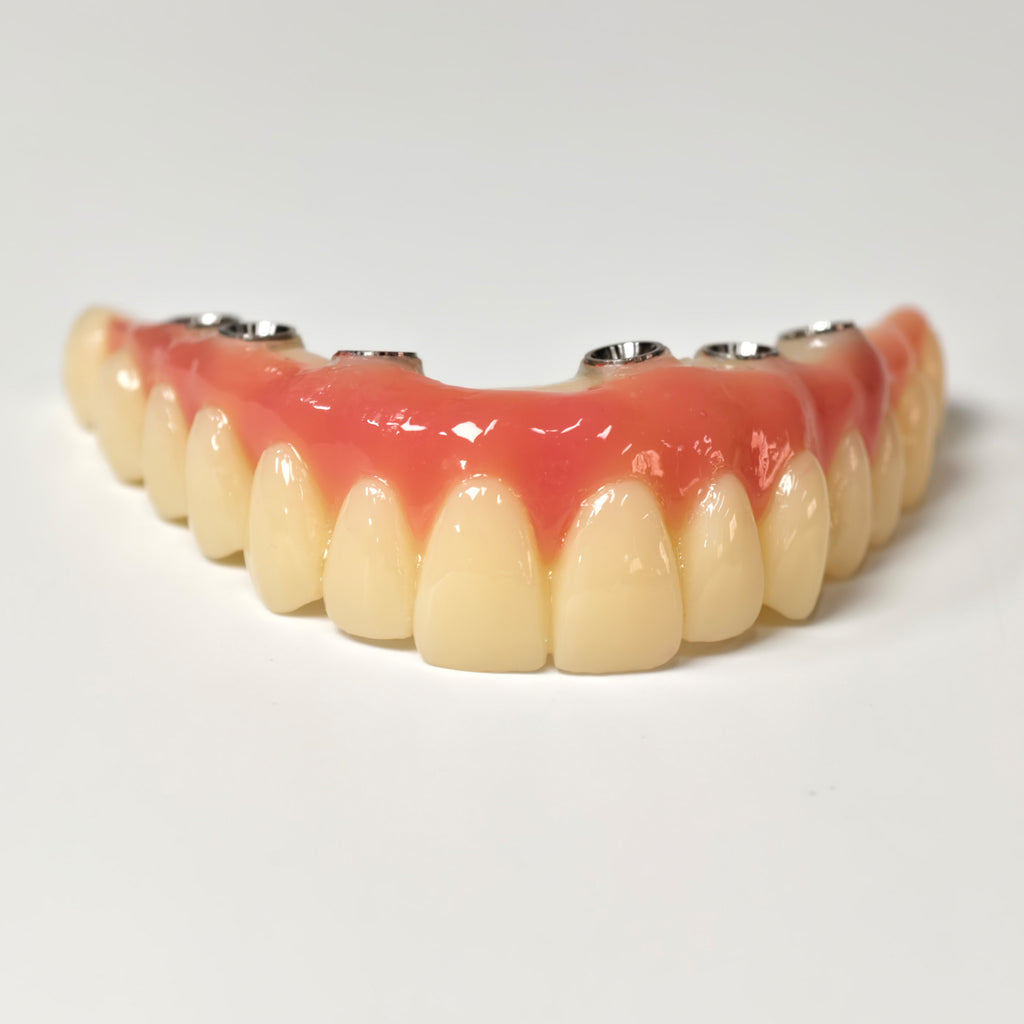PMMA Bridge With Screw Retained