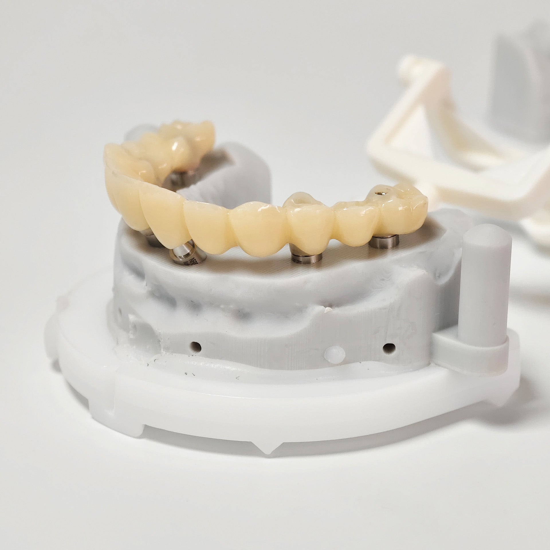PMMA Bridge With Screw Retained