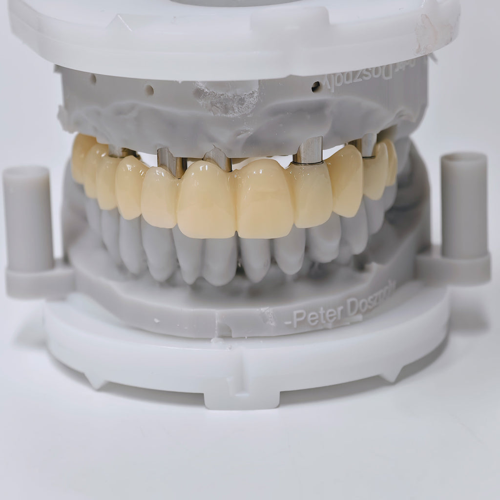 PMMA Bridge With Screw Retained