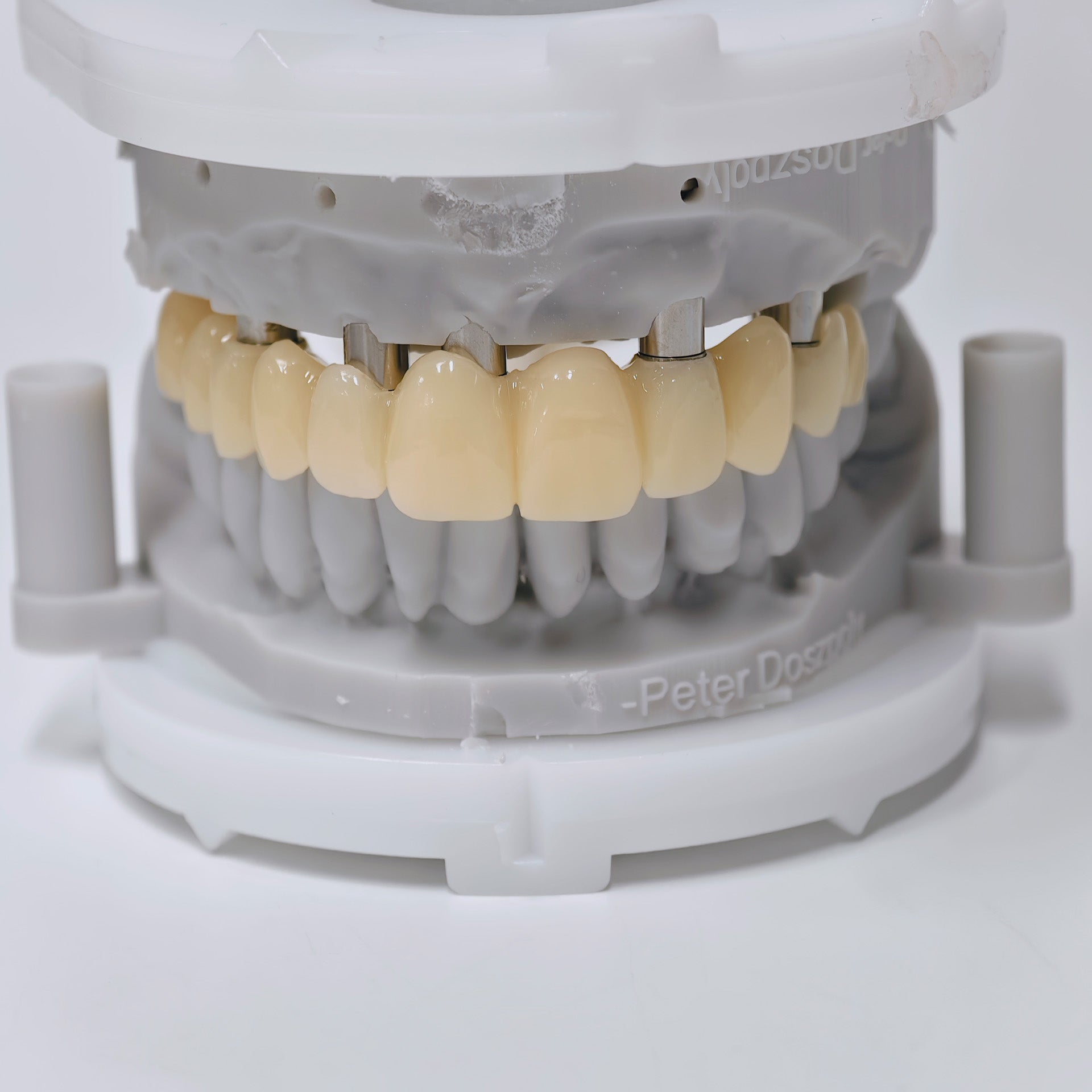 PMMA Bridge With Screw Retained