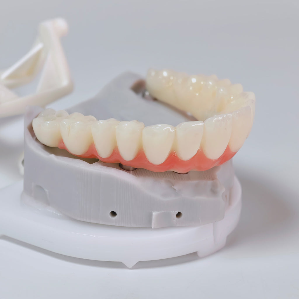 PMMA Bridge With Screw Retained