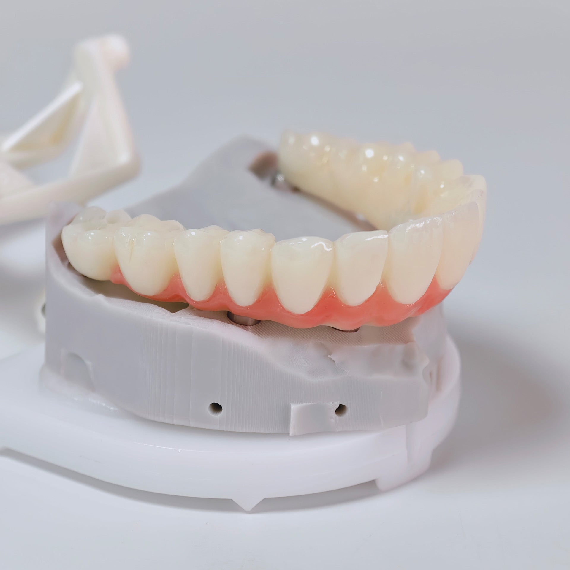 PMMA Bridge With Screw Retained