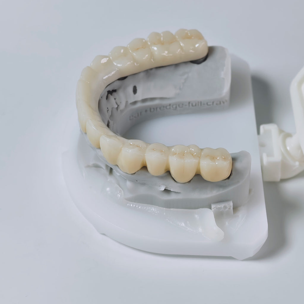 Ti-Bar Titanium Nitride Metal Frame With Zirconia Bridge And Cement Retained