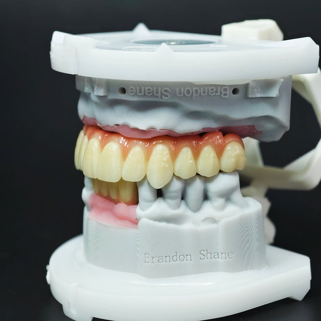 Ti-Bar Titanium Nitride Metal Frame With Zirconia Bridge For Full Arch Restoration