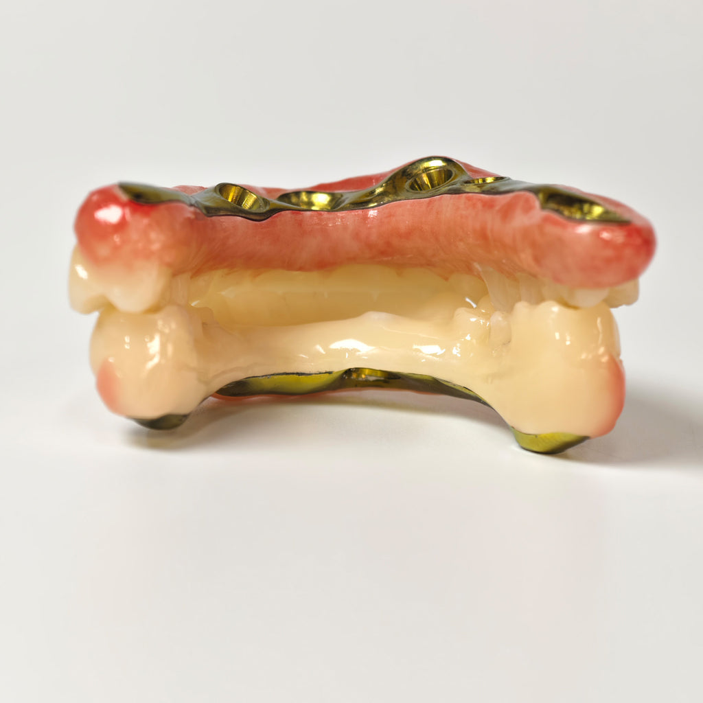 Ti-Bar Titanium Nitride Metal Frame With Zirconia Bridge For Full Arch Restoration