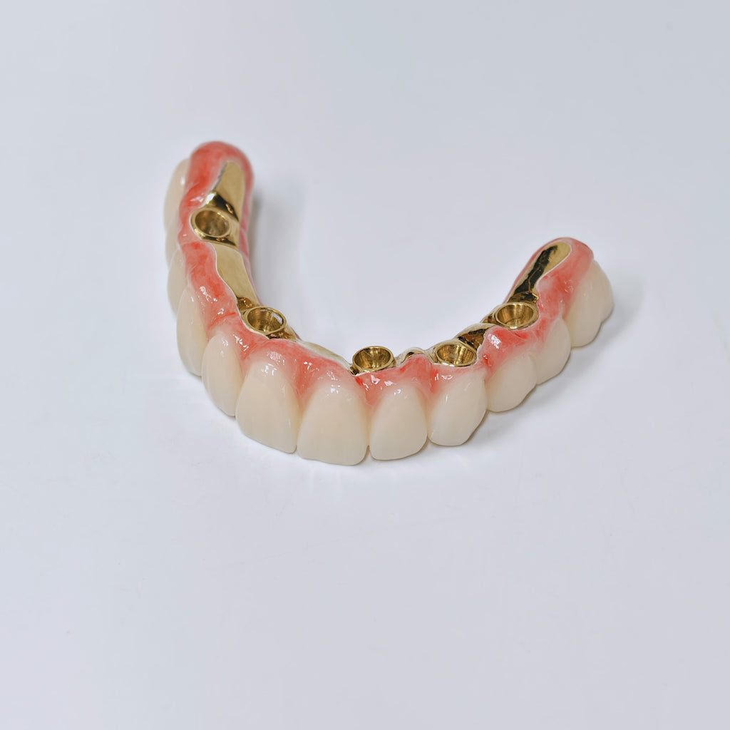 Ti-Bar Titanium Nitride Metal Frame With Zirconia Bridge For Full Arch Restoration