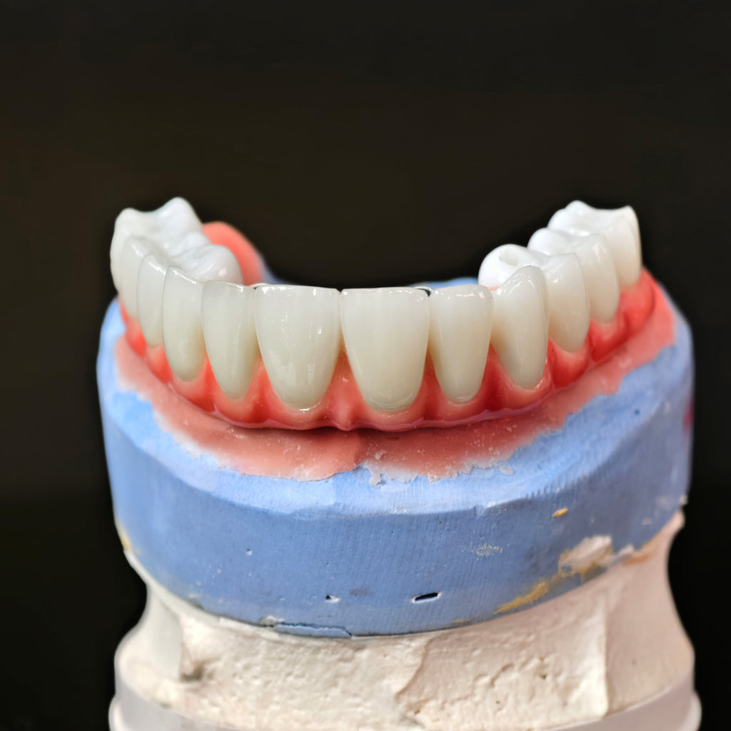 Traditional Malo Bridge With Alloy Framework Covering The Gingiva