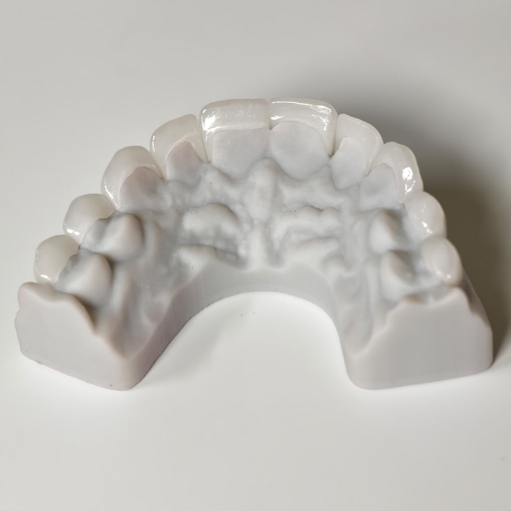 Ultra-Thin Emax Veneer. High Transparency/Translucent, Natural Shade