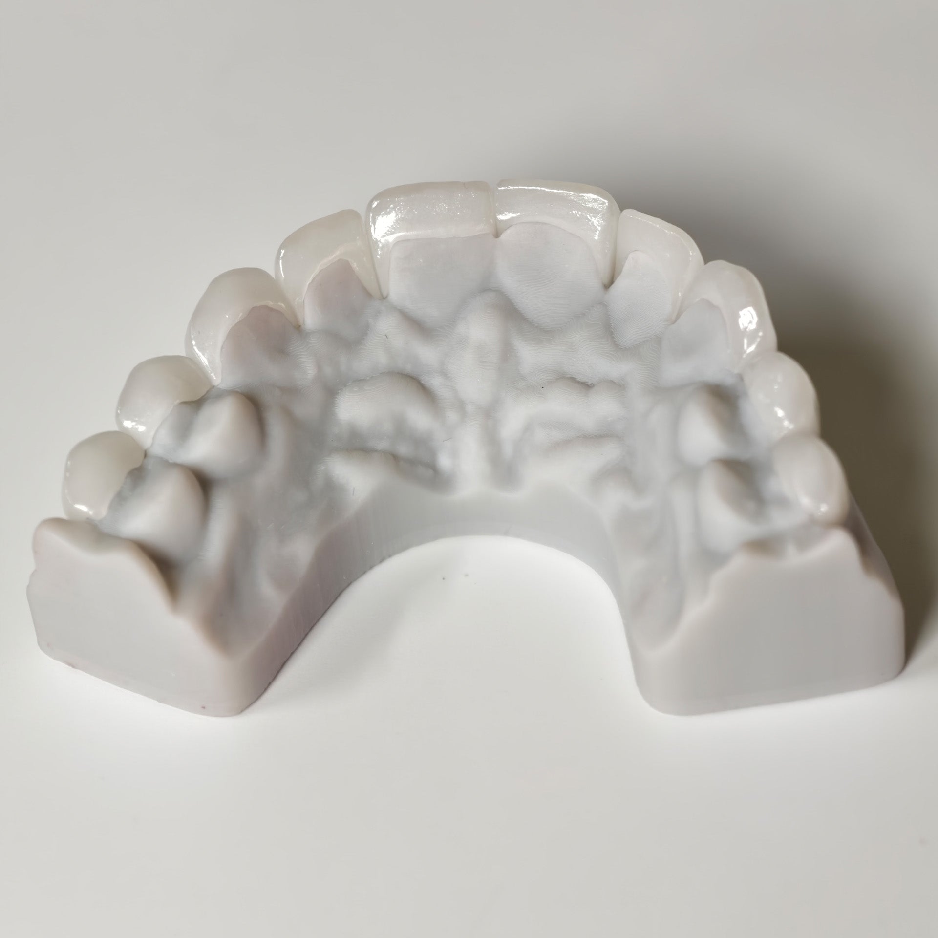 Ultra-Thin Emax Veneer. High Transparency/Translucent, Natural Shade
