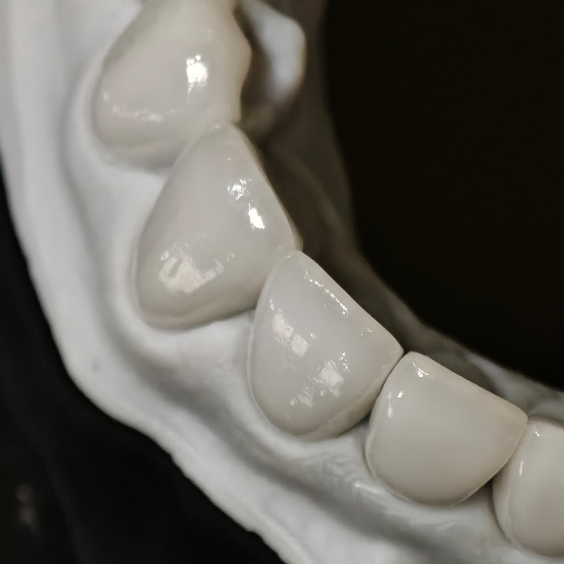 Ultra-Thin Emax Veneer. High Transparency/Translucent, Natural Shade