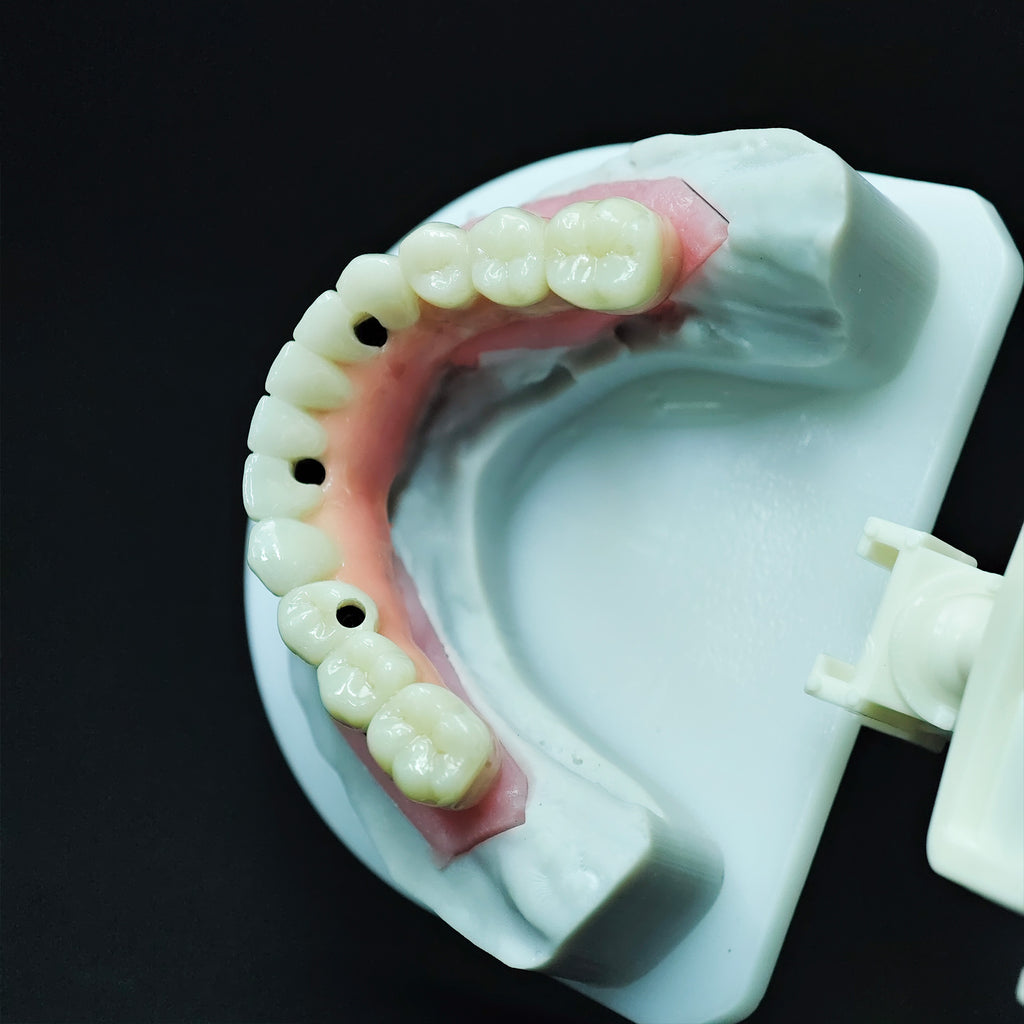 Zirconia-Enamel Hybrid Malo Bridge