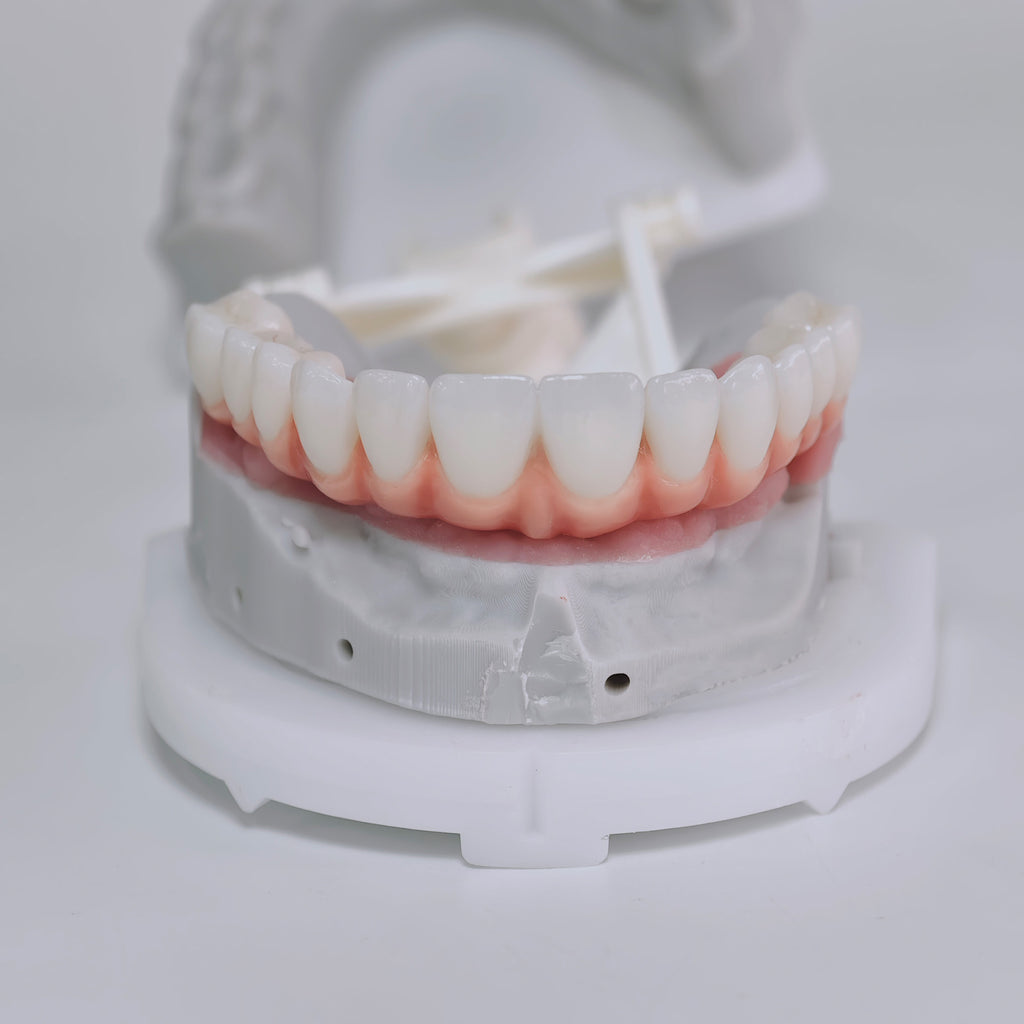 Zirconia-Enamel Hybrid Malo Bridge Aesthetic