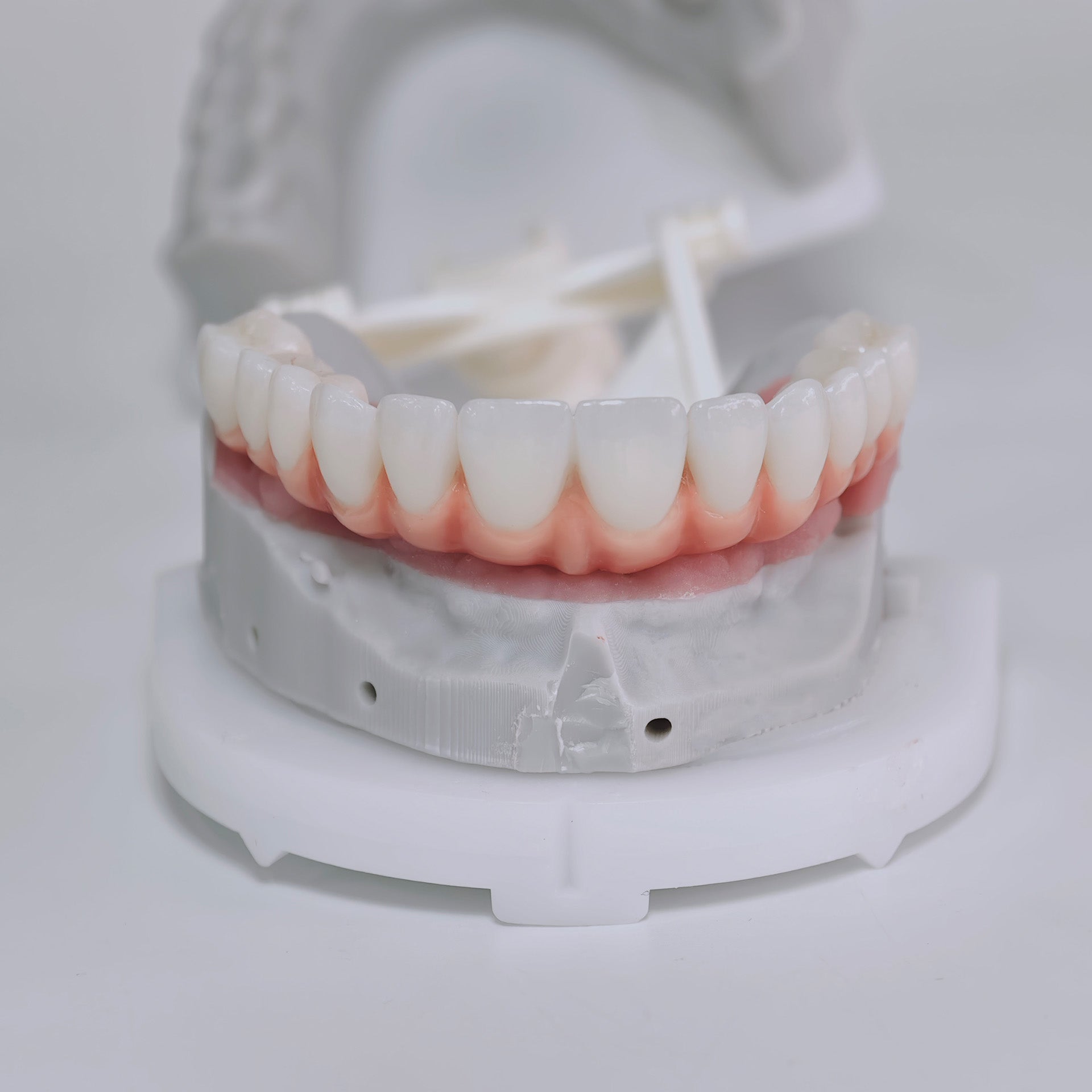 Zirconia-Enamel Hybrid Malo Bridge Aesthetic