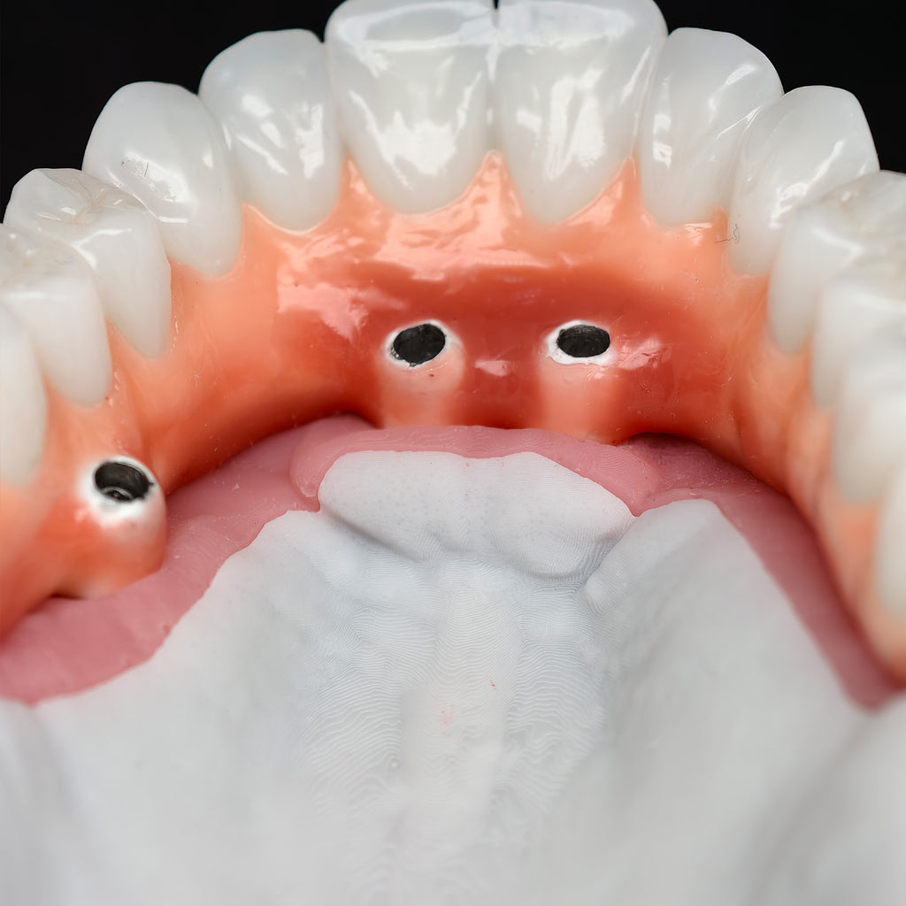 Zirconia-Enamel Hybrid Malo Bridge
