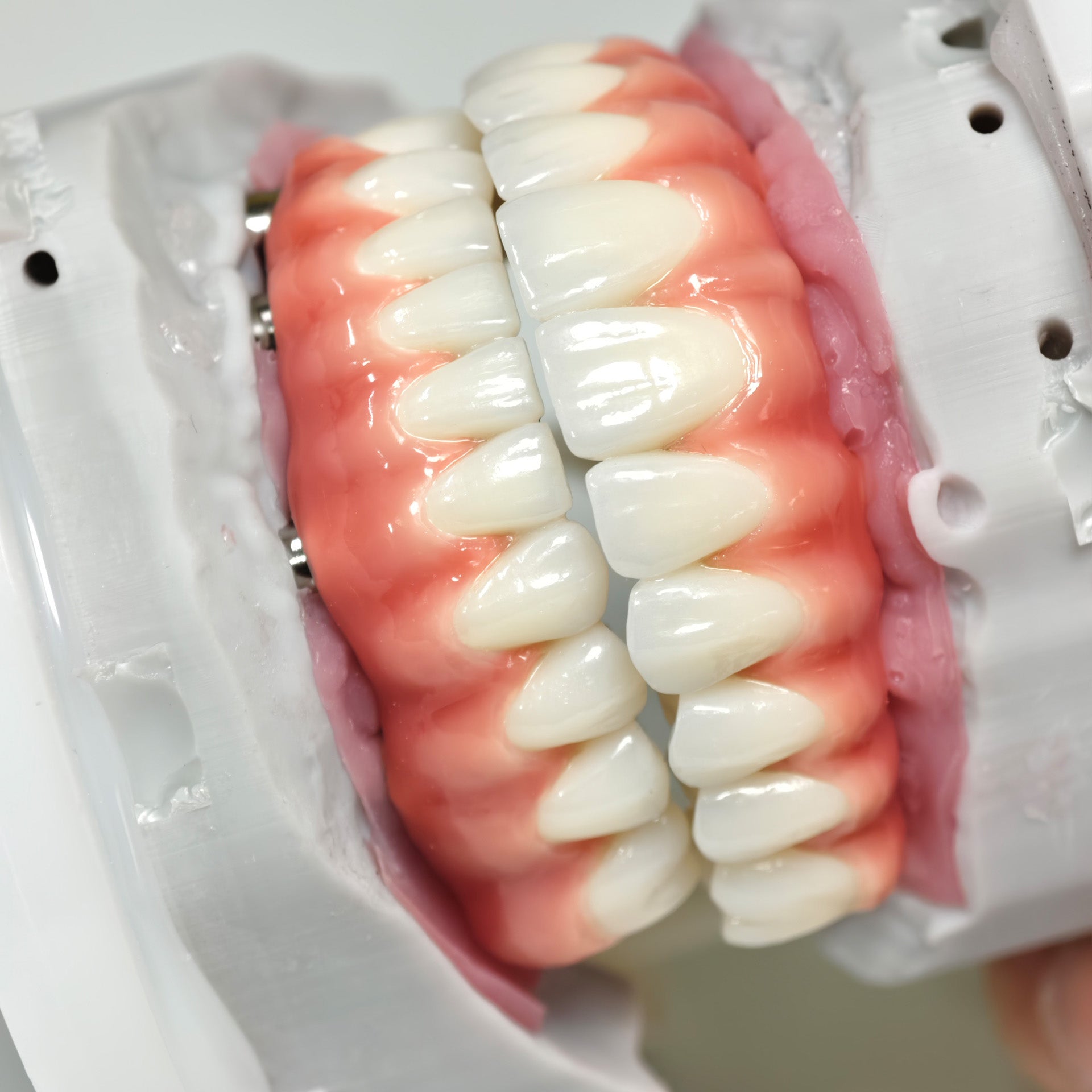 Zirconia-Enamel Hybrid Malo Bridge