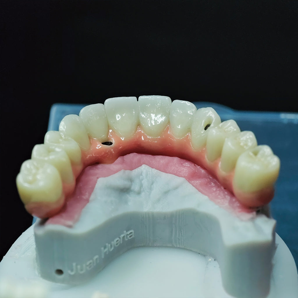 Zirconia-Enamel Hybrid Malo Bridge