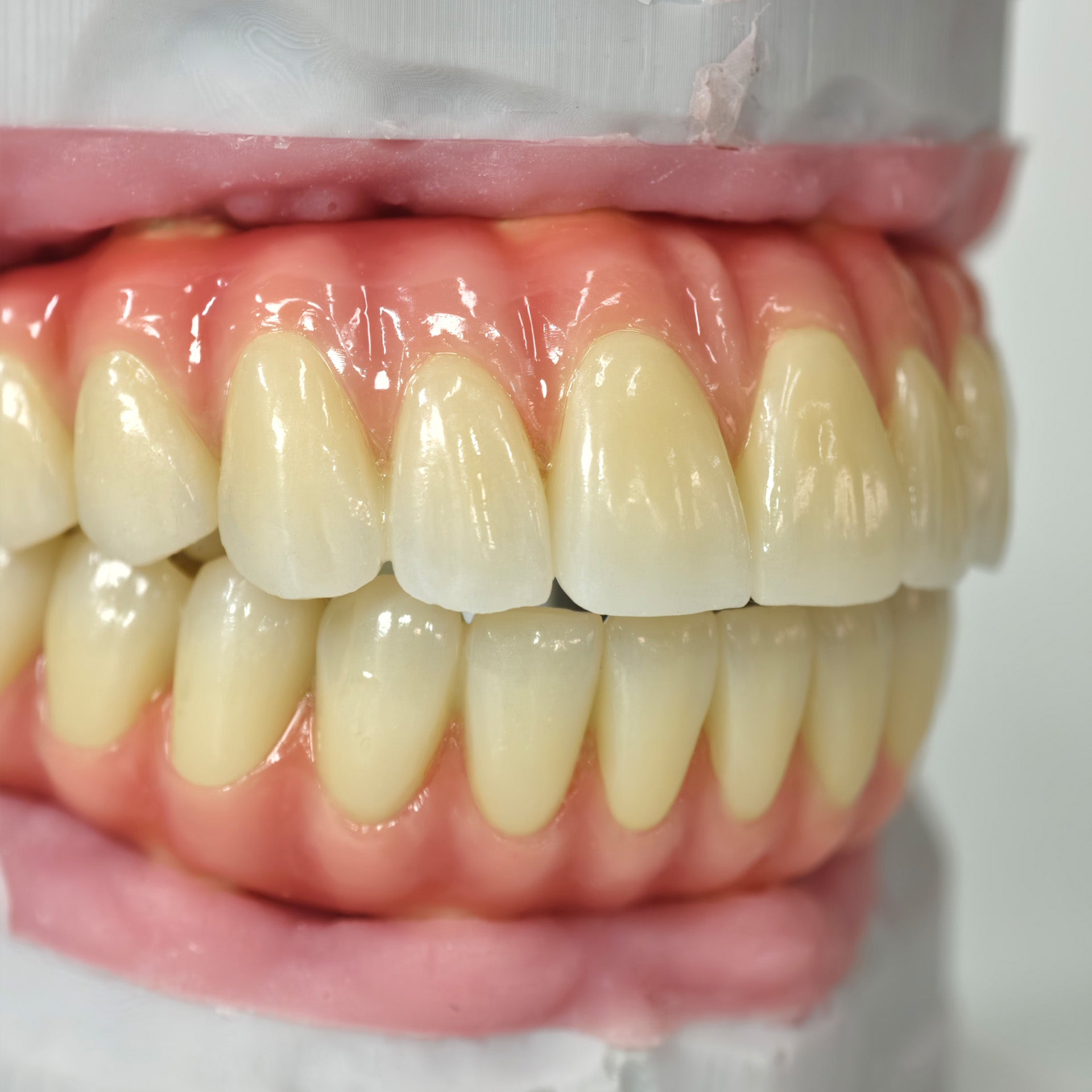 Zirconia-Enamel Hybrid Malo Bridge