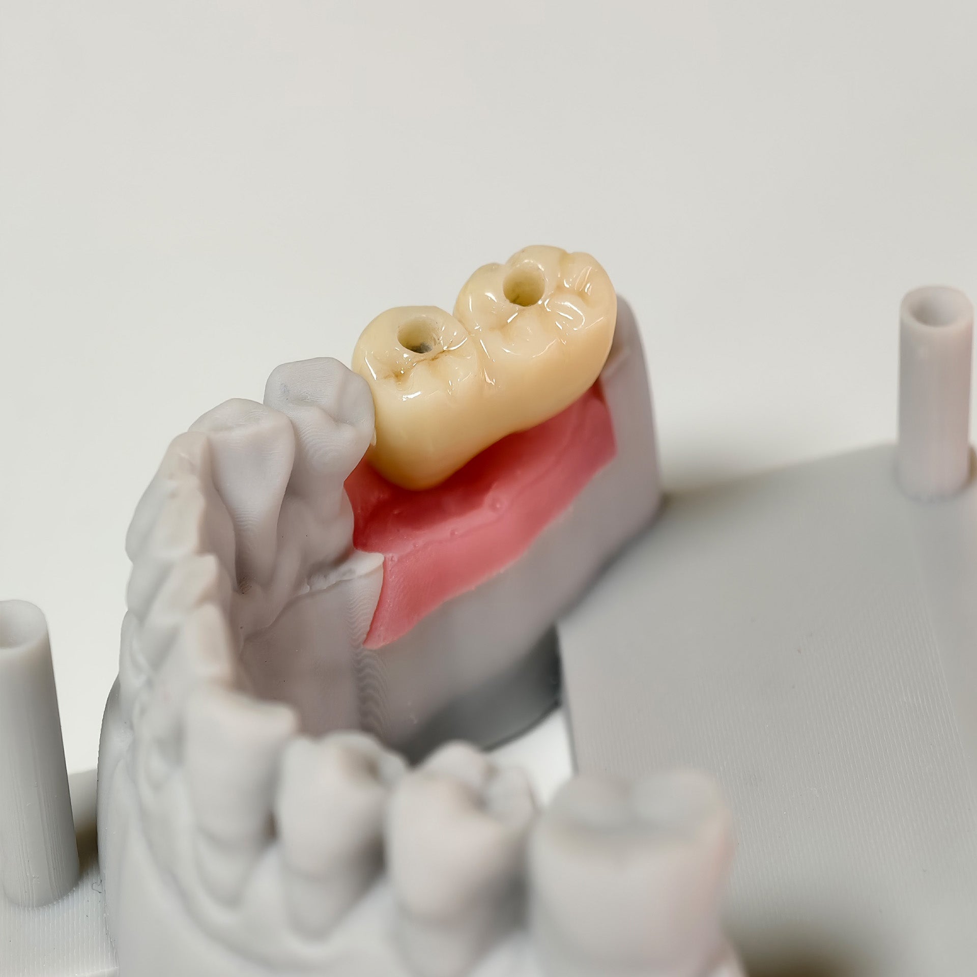 Zirconia Bridge With Screw Retained