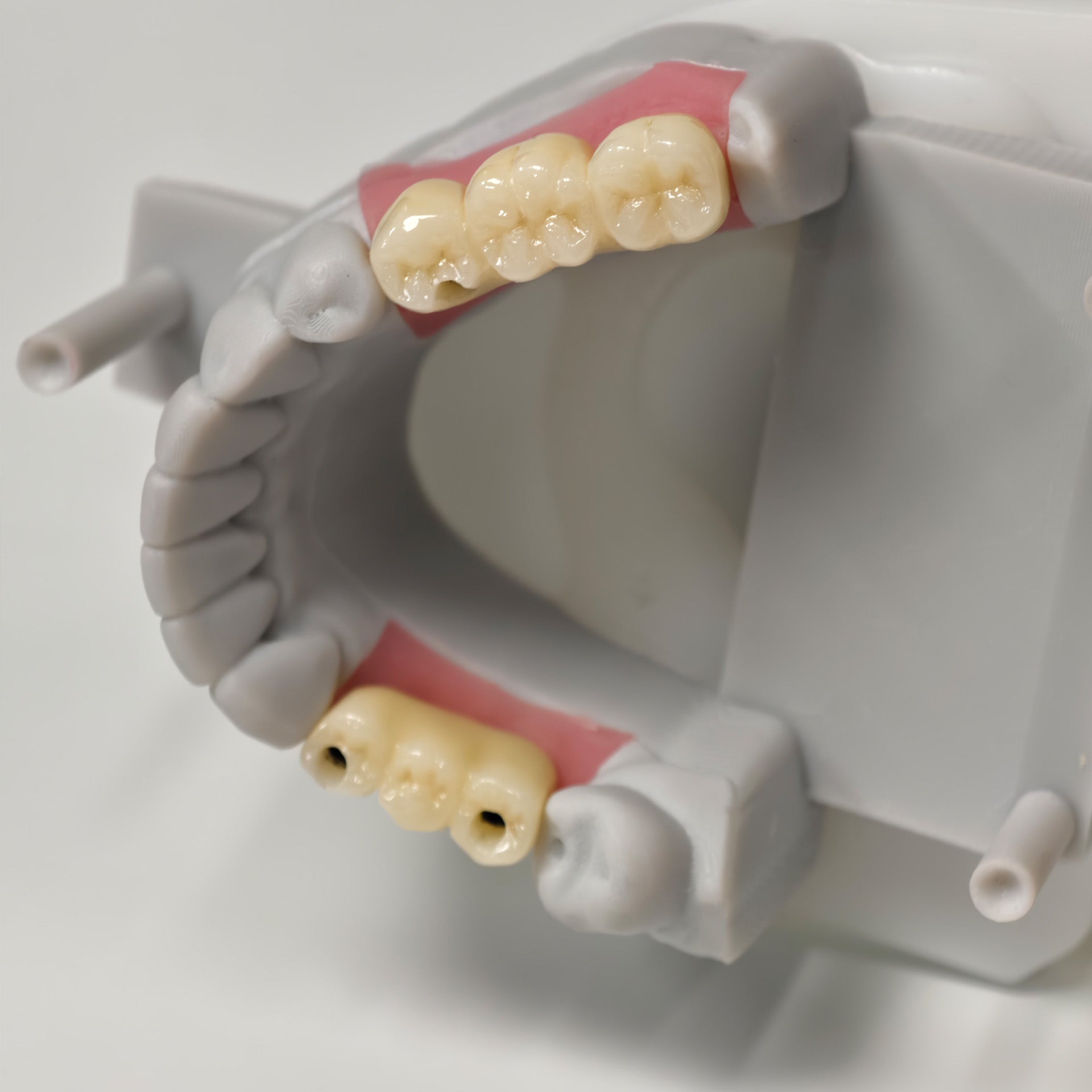 Zirconia Bridges With Screw Retained