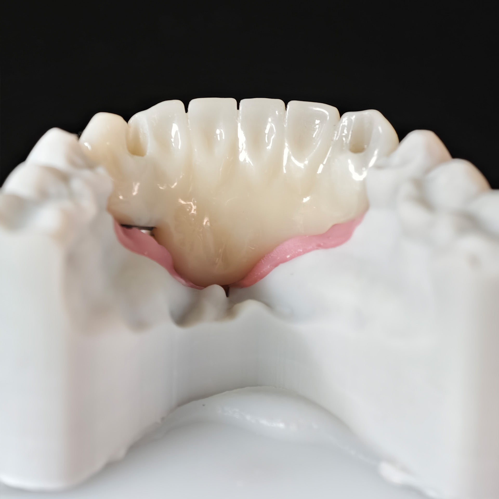 Zirconia Bridge With Ti-Base Screw Retained
