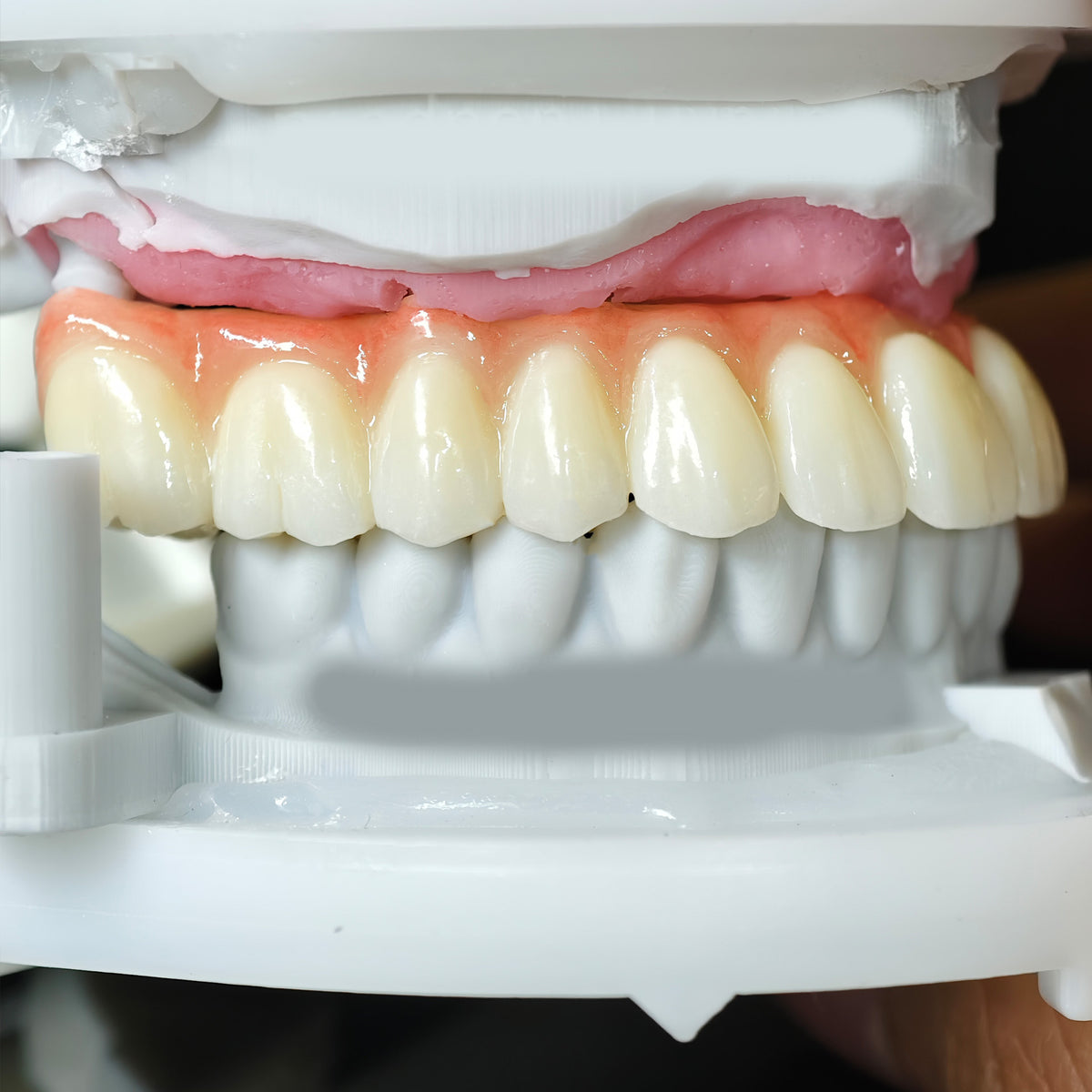 Zirconia Bridge With Cement Retained