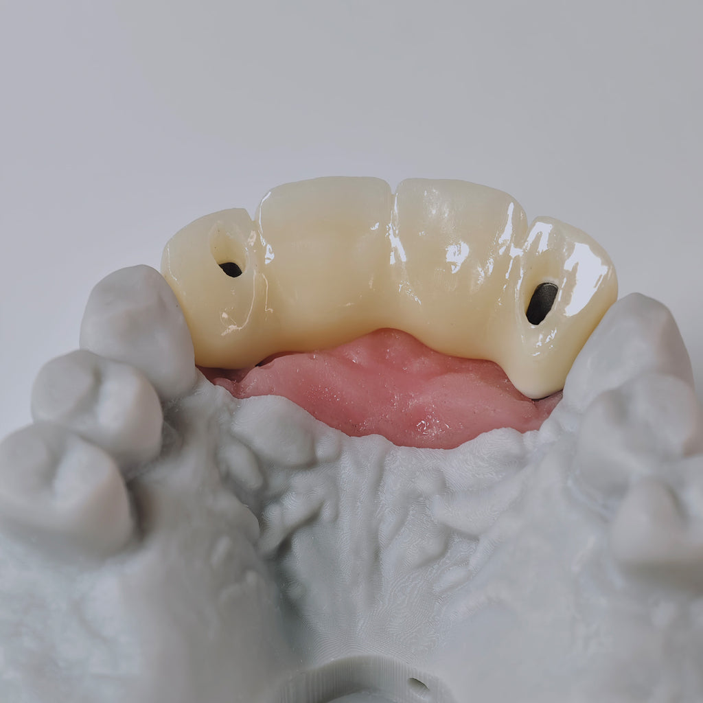 Zirconia Bridge With Screw Retained