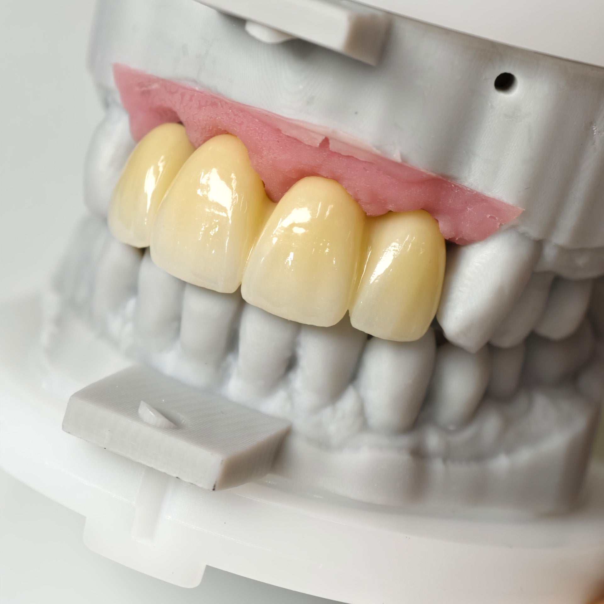 Zirconia Bridge With Screw Retained