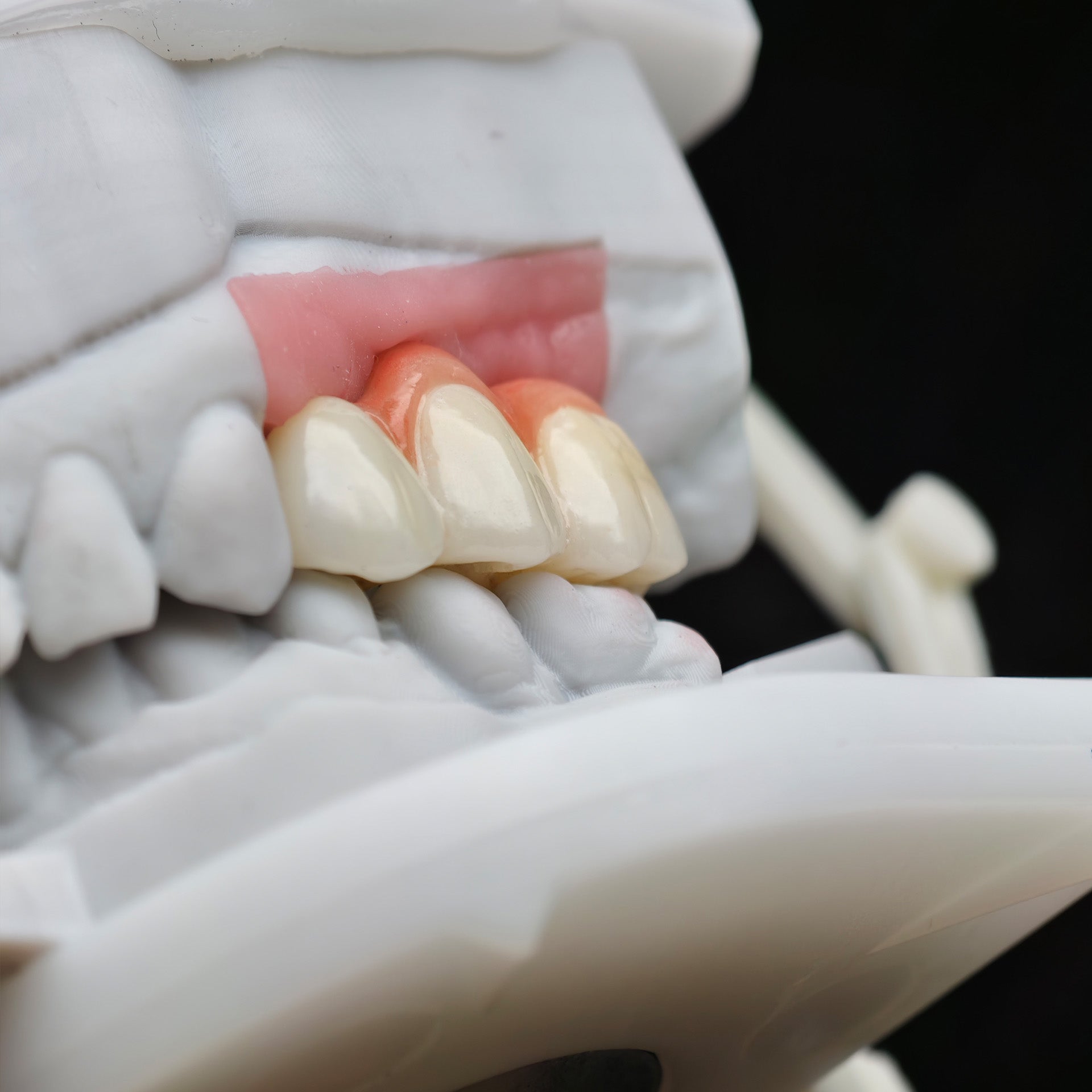 Zirconia Bridge With Screw Retained