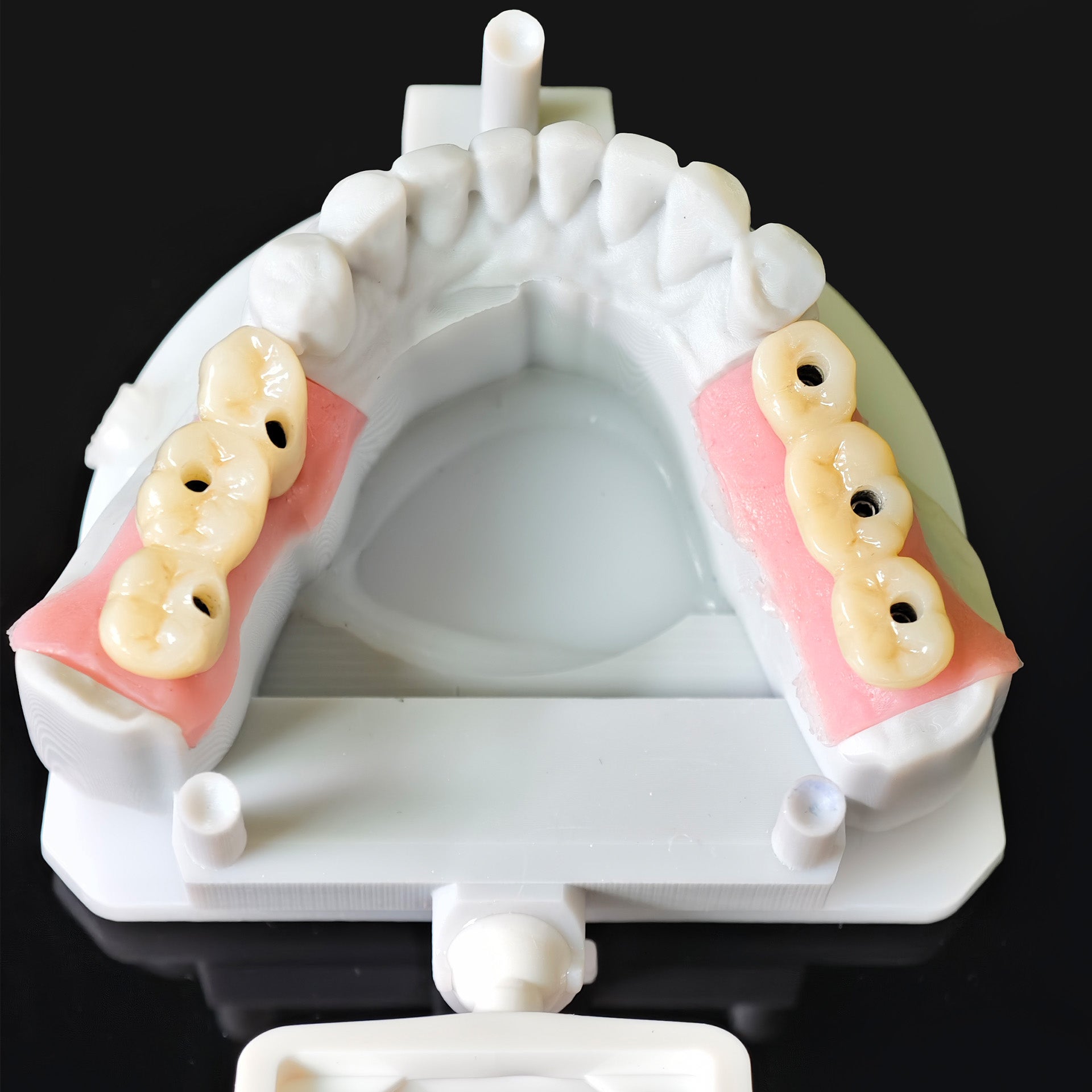 Zirconia Bridge With Screw Retained Gold Plating