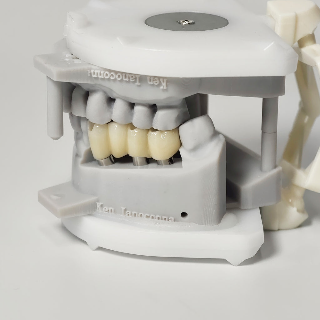 Zirconia Bridge With Ti-Base Screw Retained