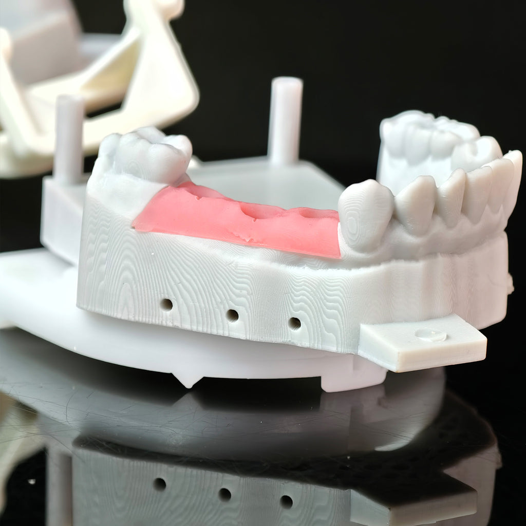 Zirconia Crowns With Gold-Plated Abutment And Implant Seating Guide