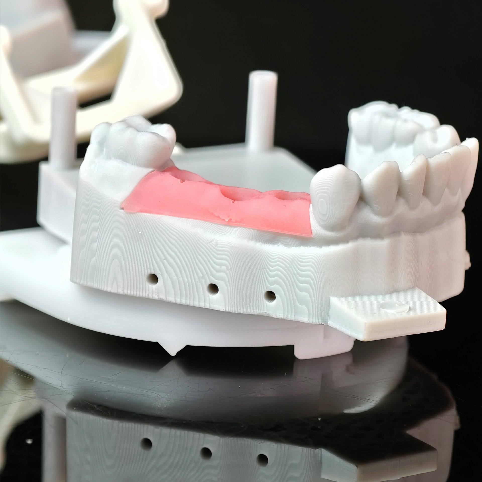 Zirconia Crowns With Gold-Plated Abutment And Implant Seating Guide