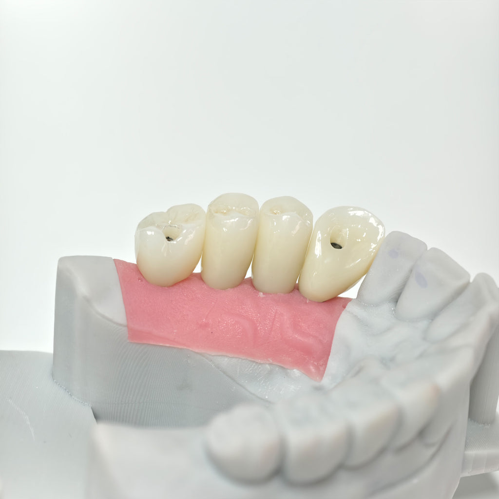 Zirconia Crowns With Screw Retained