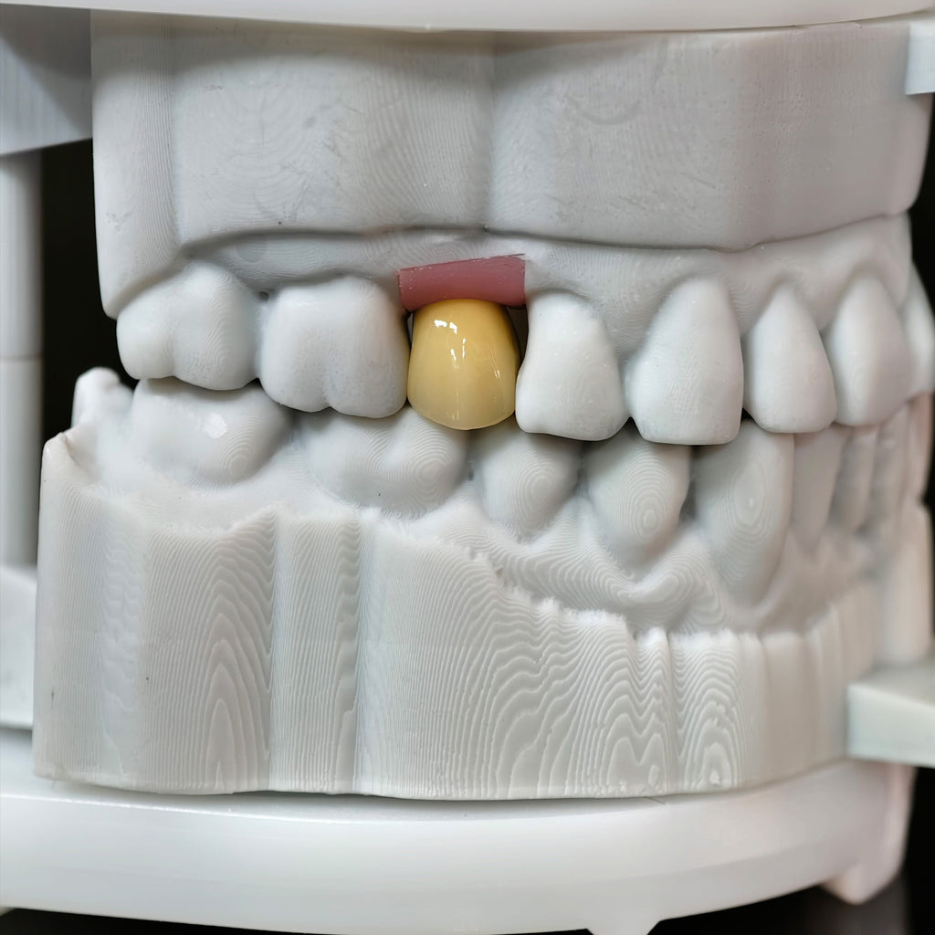 Zirconia Crowns With Screw Retained