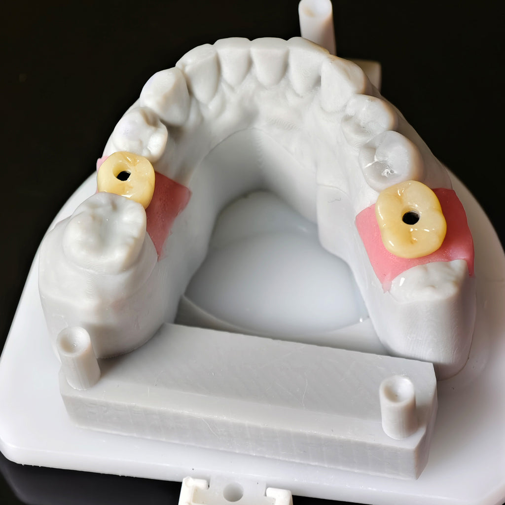Zirconia Crowns With Screw Retained