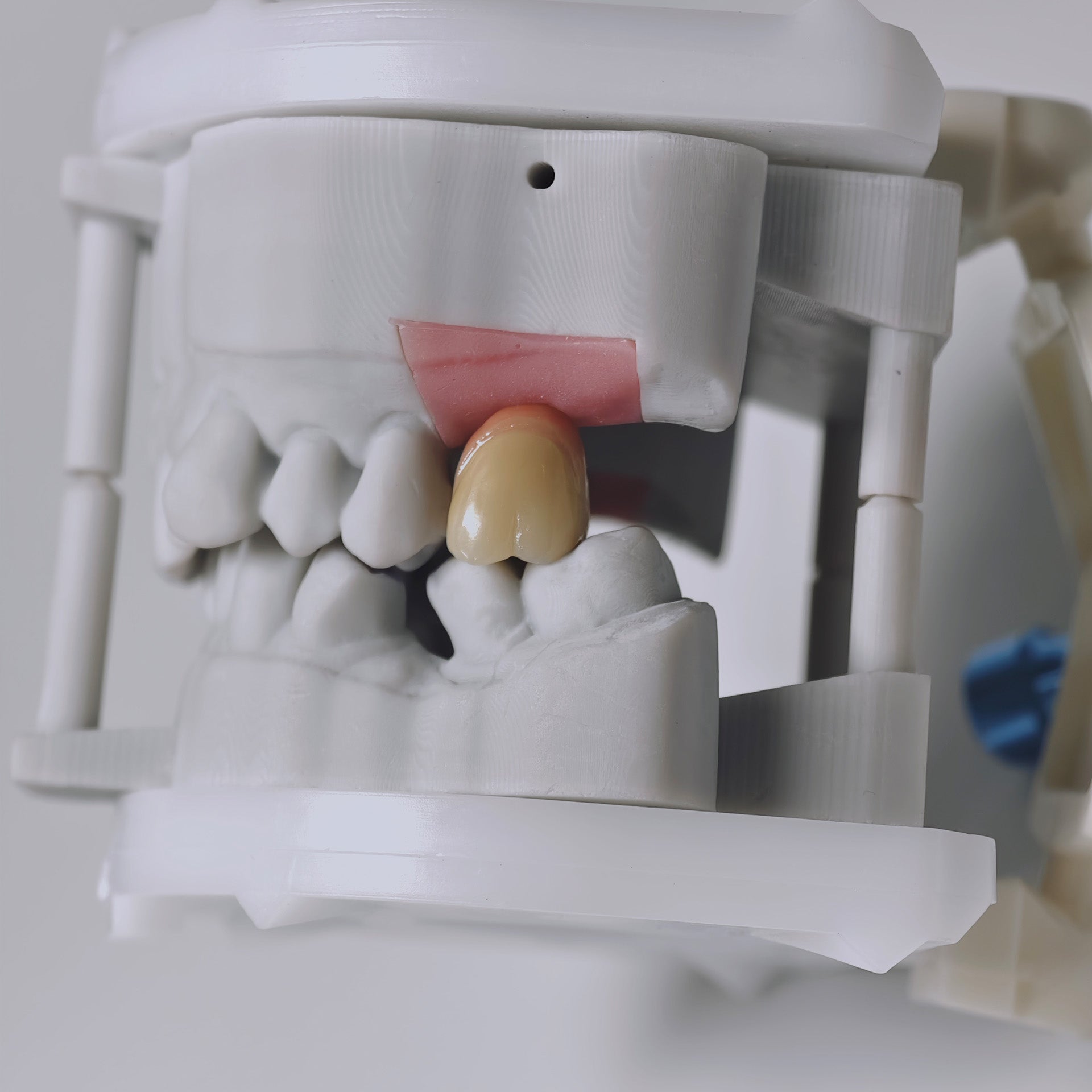 Zirconia Crowns With Screw Retained
