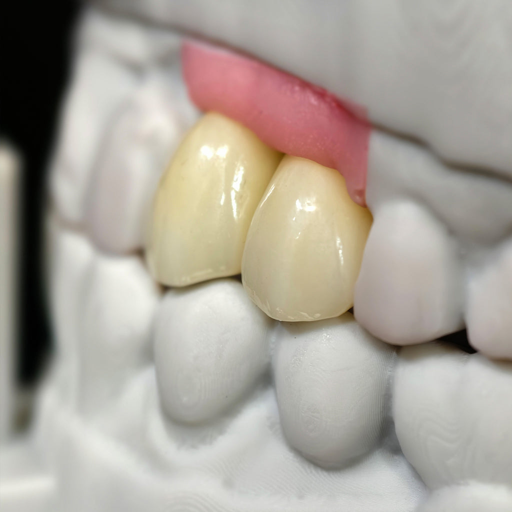 Zirconia Crowns With Screw Retained