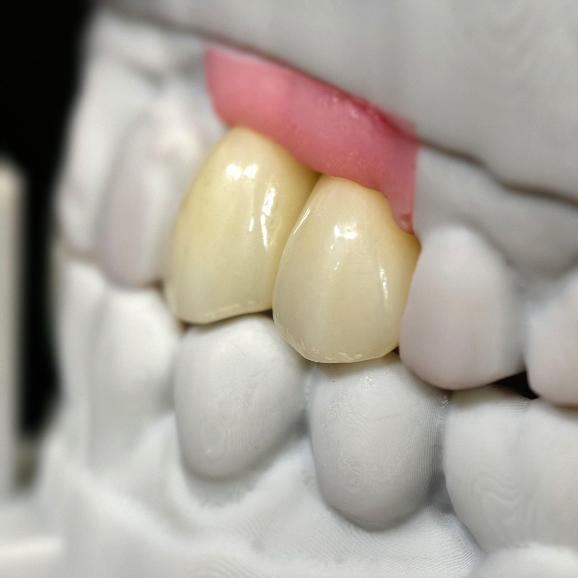 Zirconia Crowns With Screw Retained