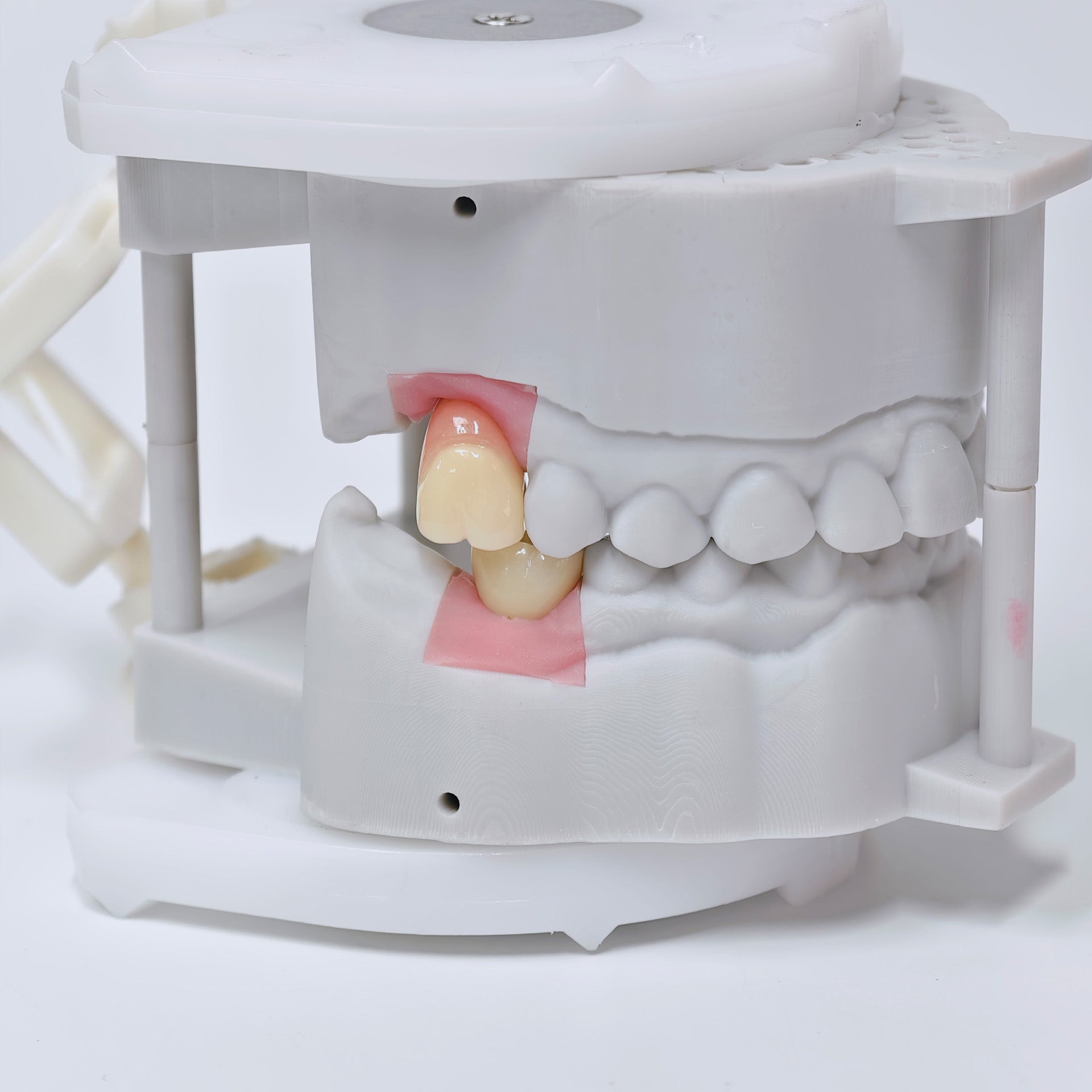 Zirconia Crowns With Screw Retained