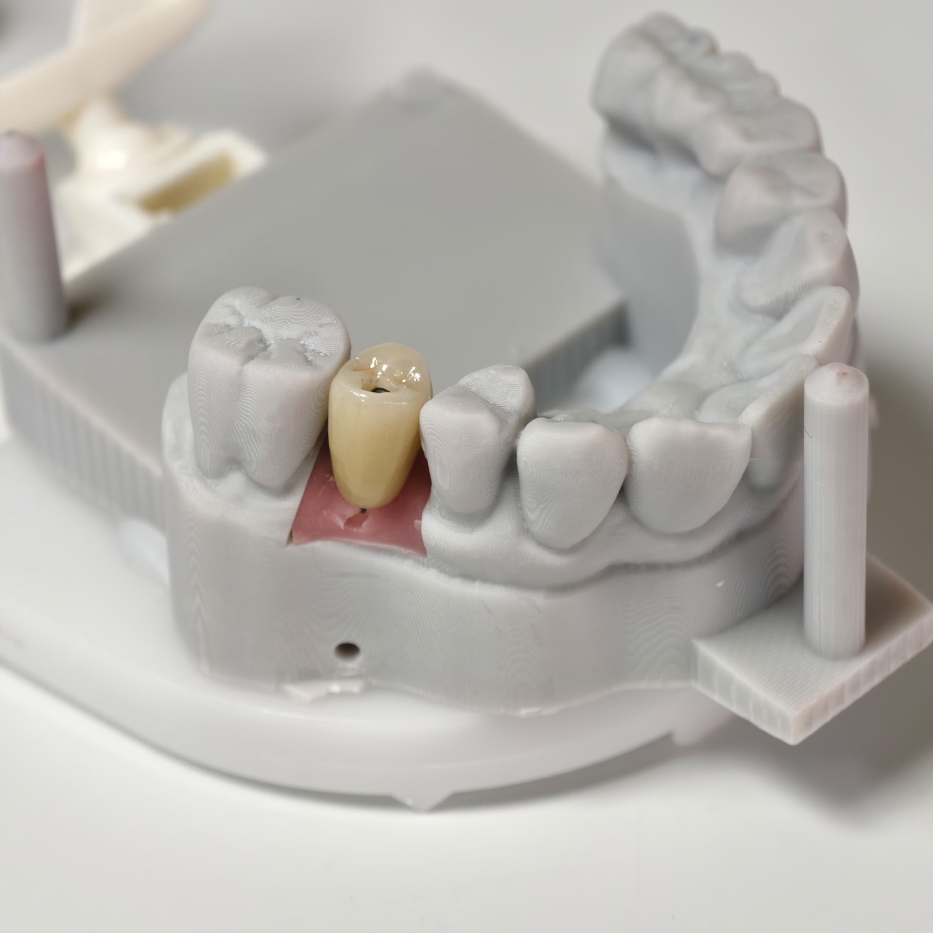Zirconia Crowns With Screw Retained