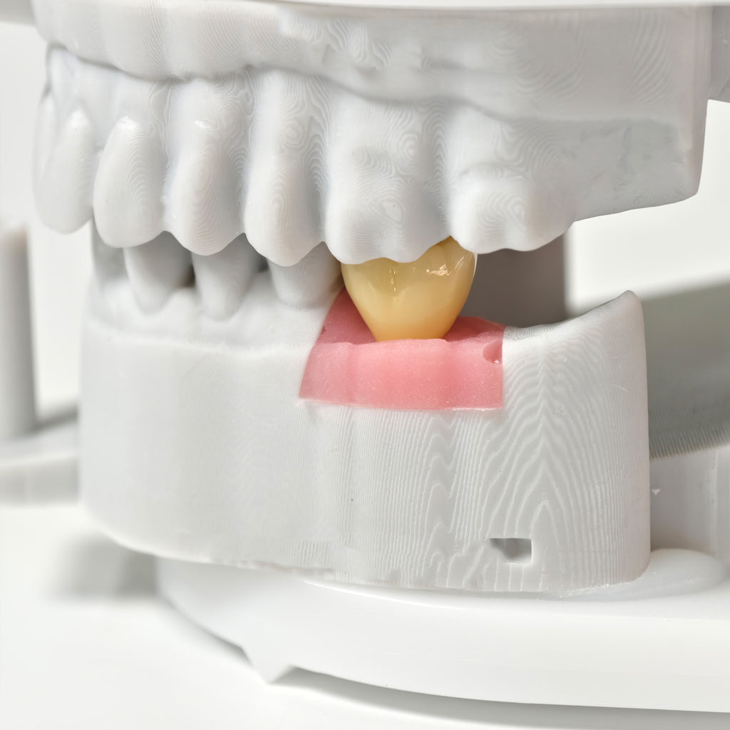 Zirconia Crowns With Screw Retained