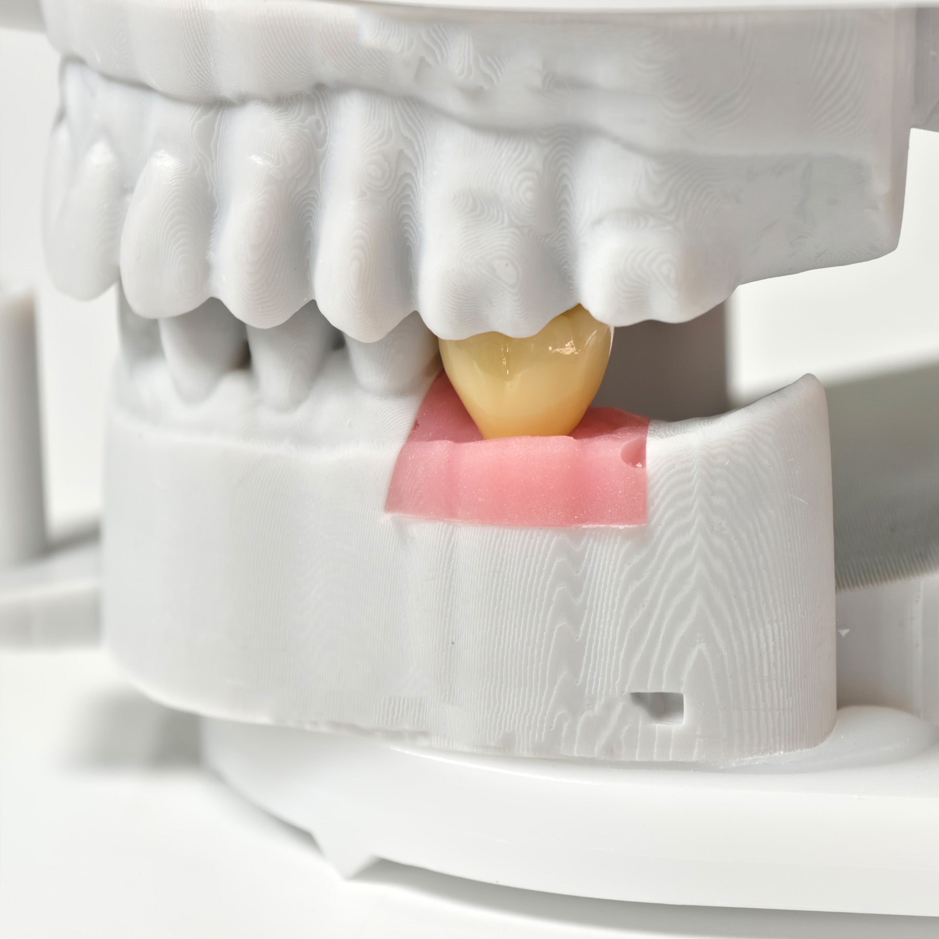 Zirconia Crowns With Screw Retained
