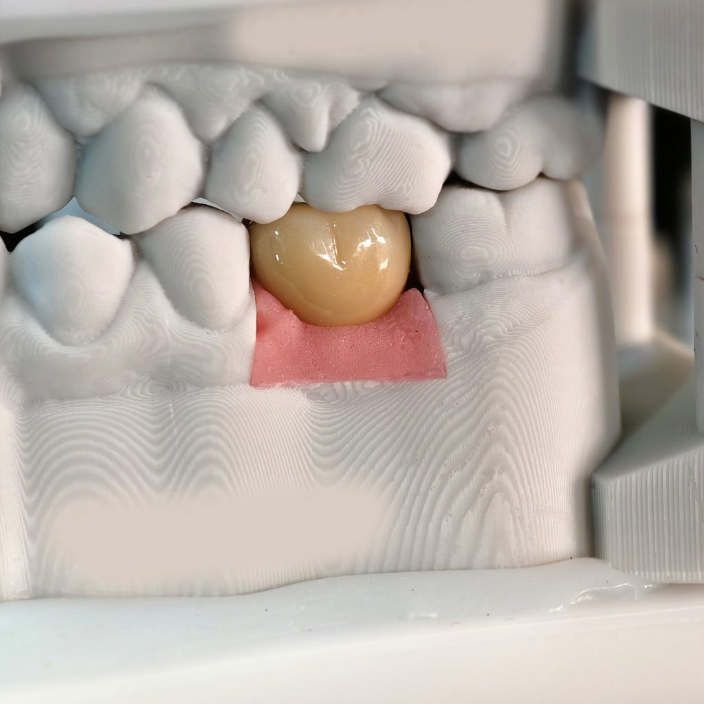 Zirconia Crowns With Screw Retained